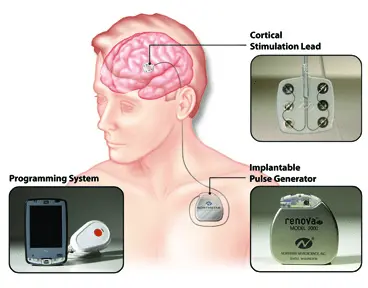 Diagram showing implantation of a Renova Pulse Generator